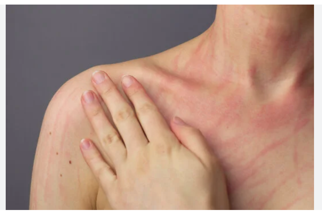My Journey with Dermatographism and the Power of Gentle Skincare